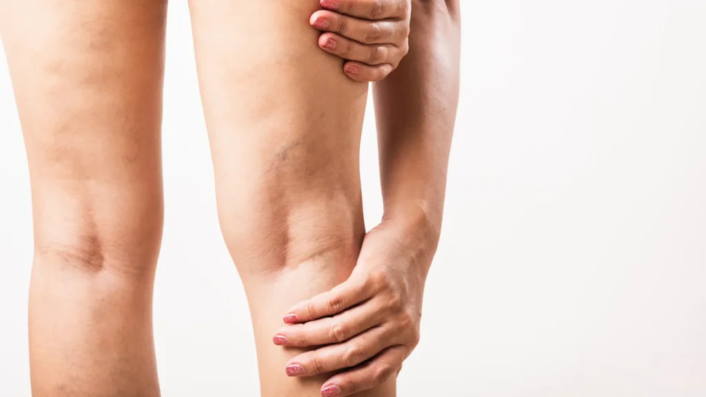 Dolor en la piernas después de saber Qué es la presoterapia Ancha Estética Cádiz