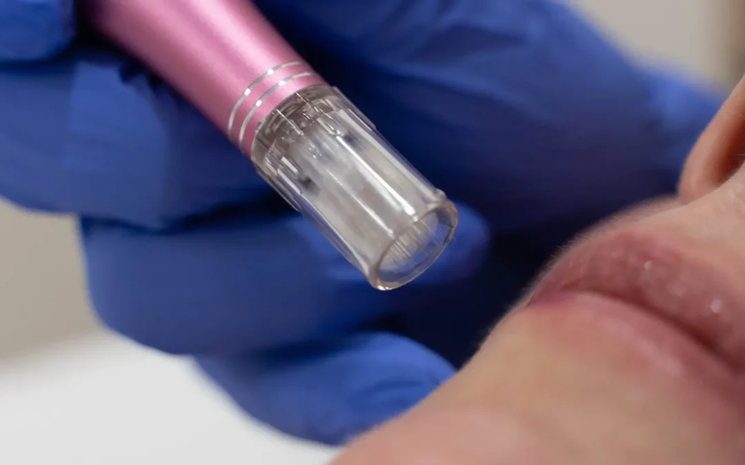 Dermapen: el tratamiento estético que regenera tu piel desde dentro