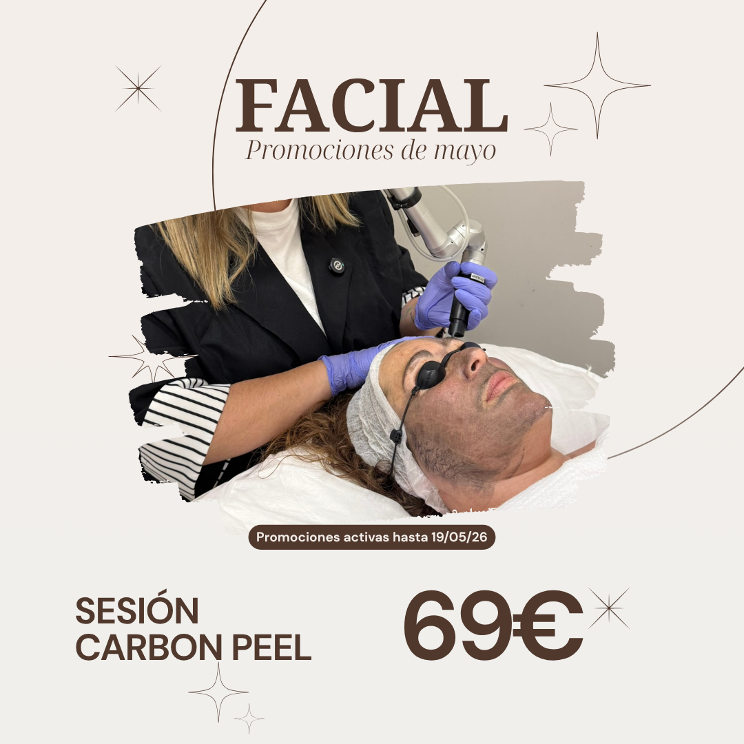 SESIÓN CARBON PEEL Ancha Estética Cádiz